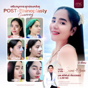 กระดูกอ่อนหลังหูของคนอื่น01