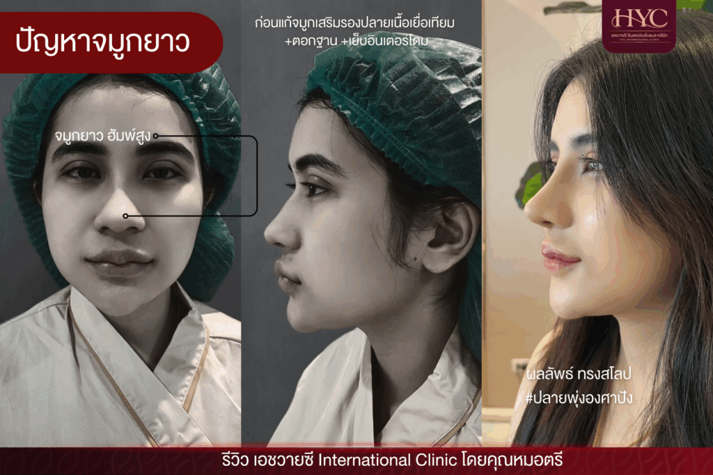 ปัญหาจมูกยาว 1