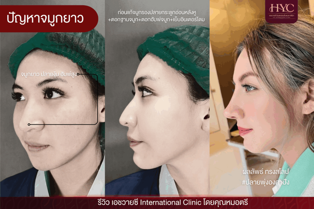 ปัญหาจมูกยาว 2