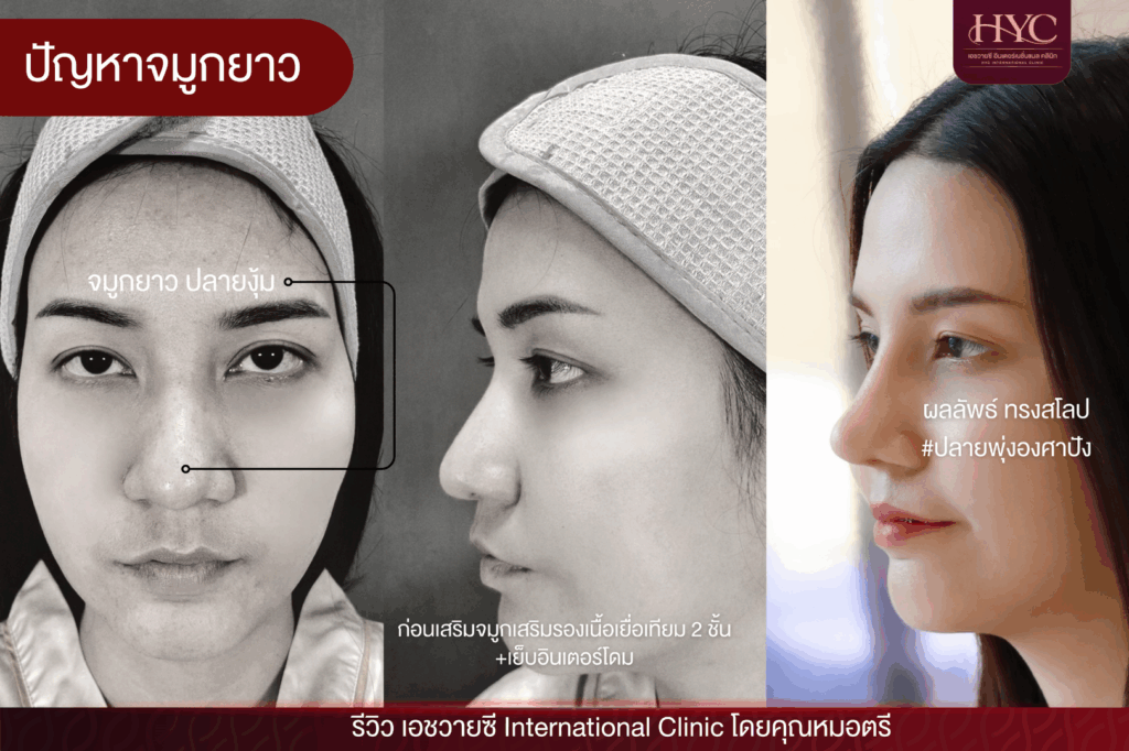 ปัญหาจมูกยาว 3