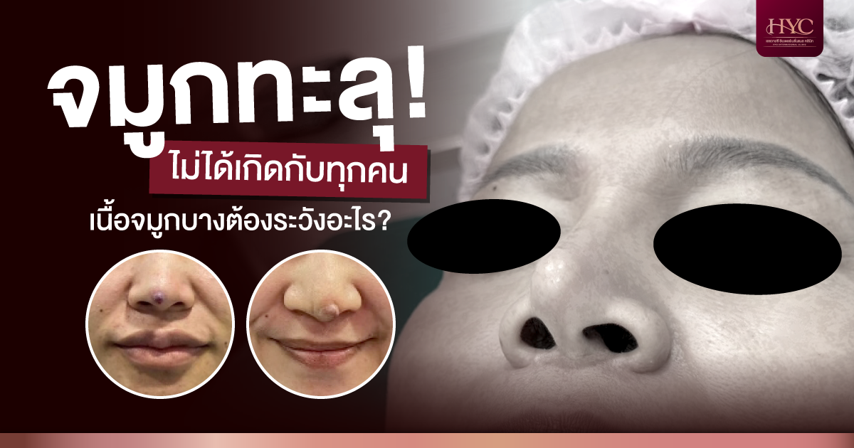 Nose Implant Extrusion