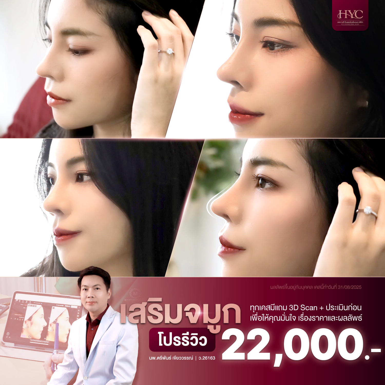 เสริมจมูก22000